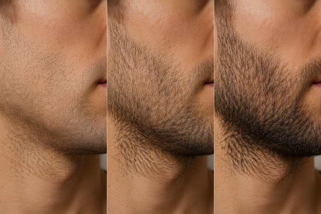 Patchy beard growth progression showing stubble becoming a fuller beard