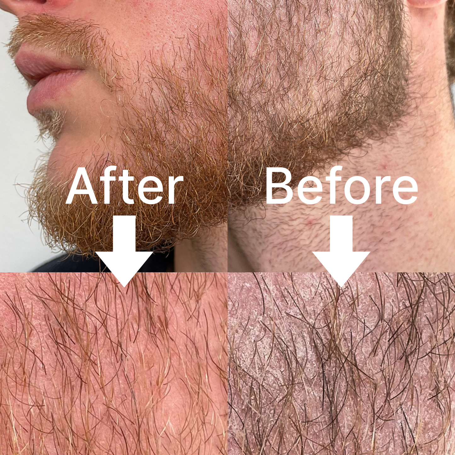Before and after comparison of beard growth with close-up details.